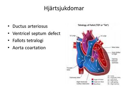 Hjärtsjukdomar Ductus arteriosus Ventricel septum defect