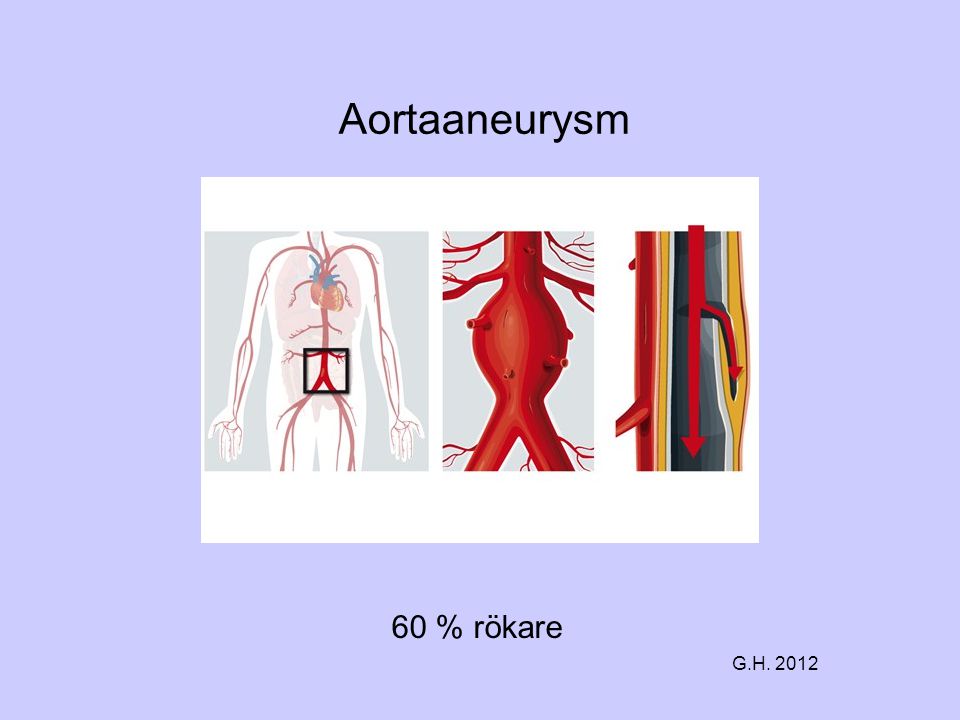 Aortaaneurysm 60 % rökare G.H. 2012