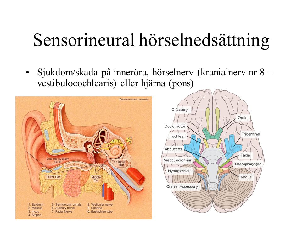 Sensorineural hörselnedsättning