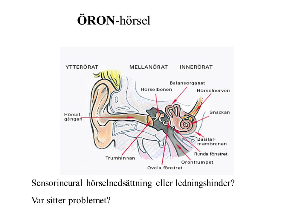 ÖRON-hörsel Sensorineural hörselnedsättning eller ledningshinder
