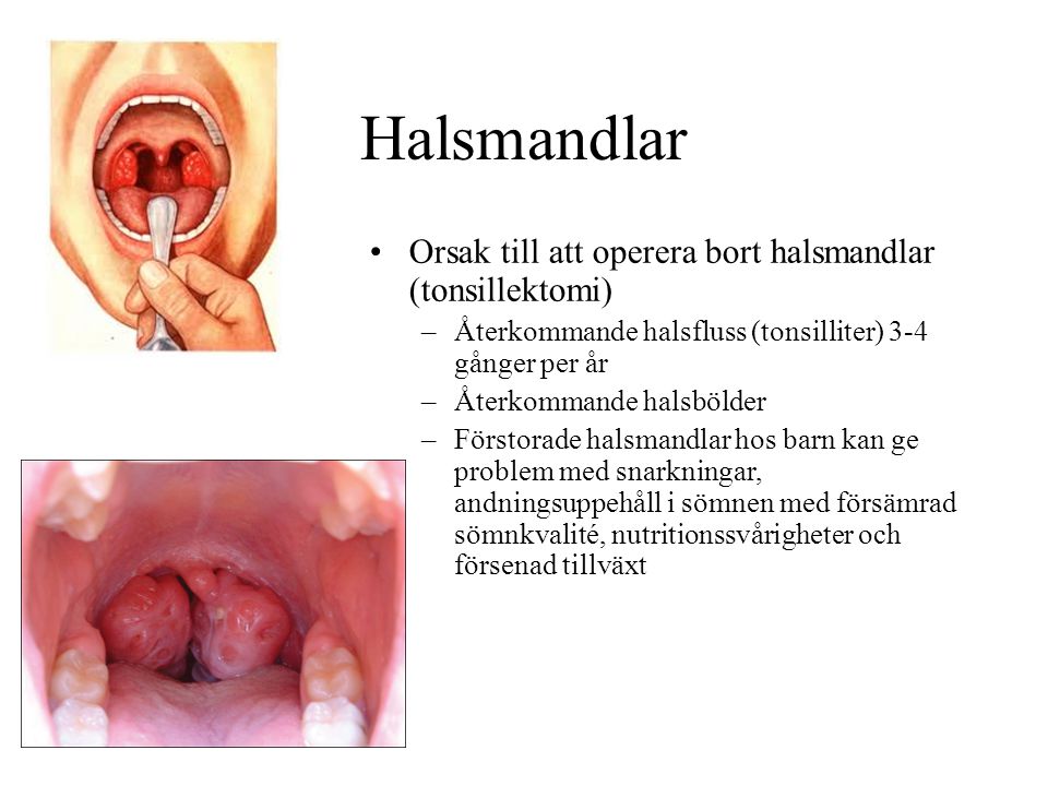 Halsmandlar Orsak till att operera bort halsmandlar (tonsillektomi)