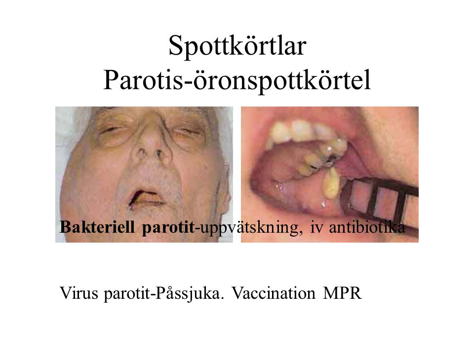 Spottkörtlar Parotis-öronspottkörtel