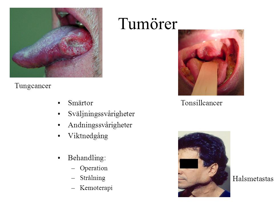 Tumörer Tungcancer Smärtor Sväljningssvårigheter Andningssvårigheter