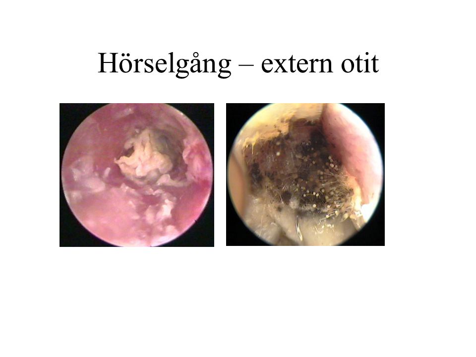 Hörselgång – extern otit