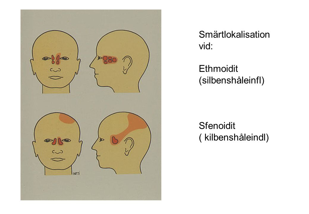 Smärtlokalisation vid: Ethmoidit (silbenshåleinfl) Sfenoidit ( kilbenshåleindl)