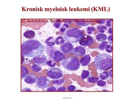 2014-05-27 Kronisk myeloisk leukemi (KML). 2014-05-27 KML - sammanfattning Cirka 90 fall/år i Sverige (m>f) Klonal stamcellssjukdom men utmognad, hyperaktiv.