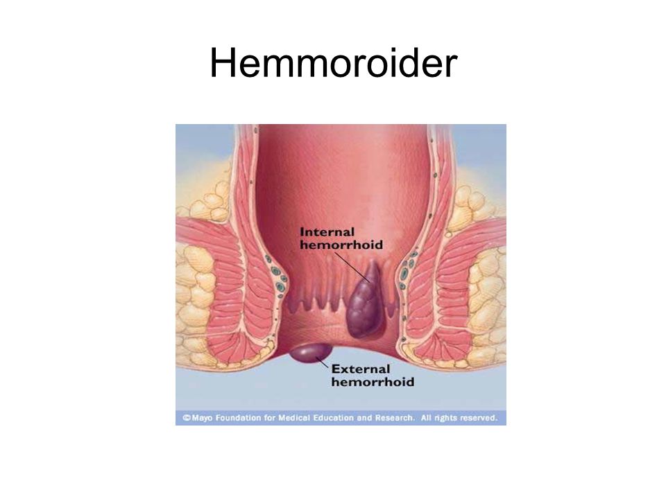 Hemmoroider