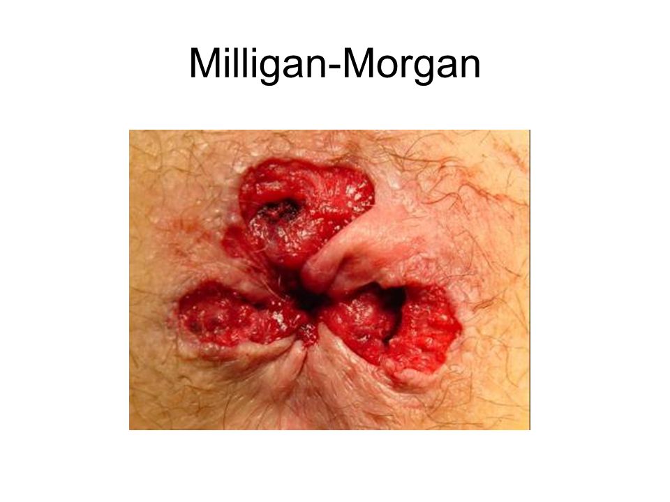 Milligan-Morgan