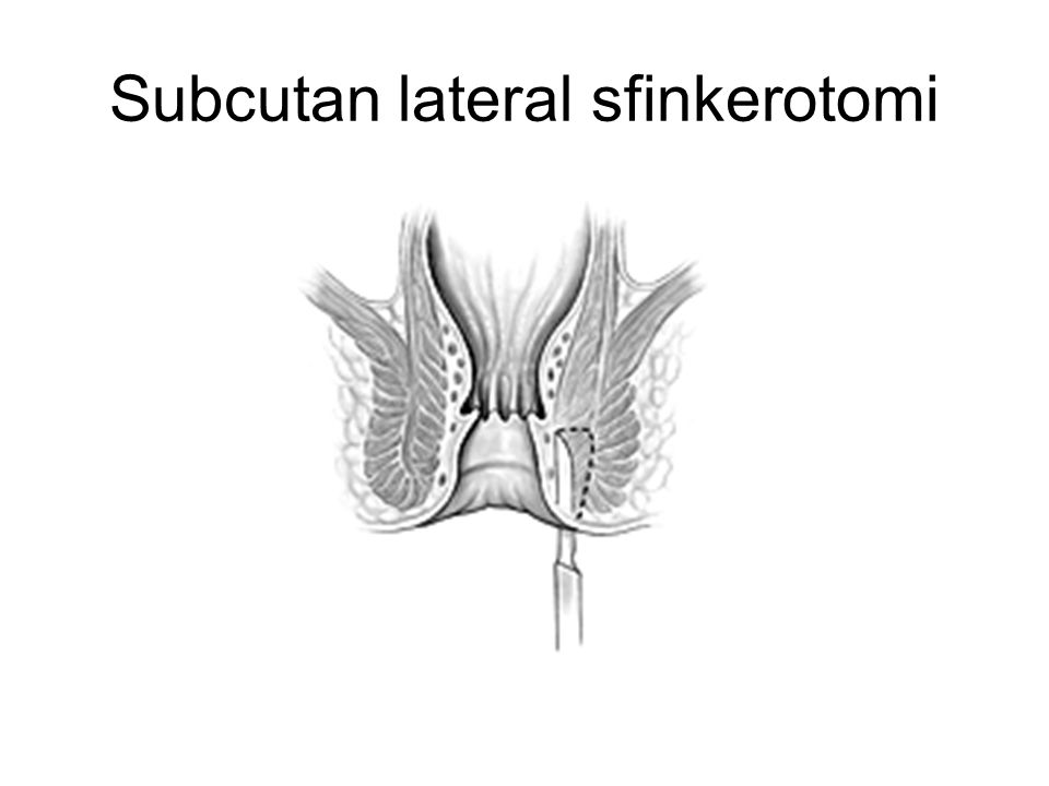 Subcutan lateral sfinkerotomi