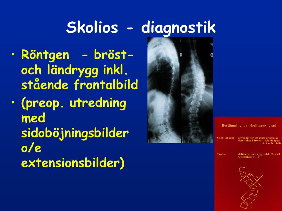Skolios - diagnostik Röntgen - bröst- och ländrygg inkl.