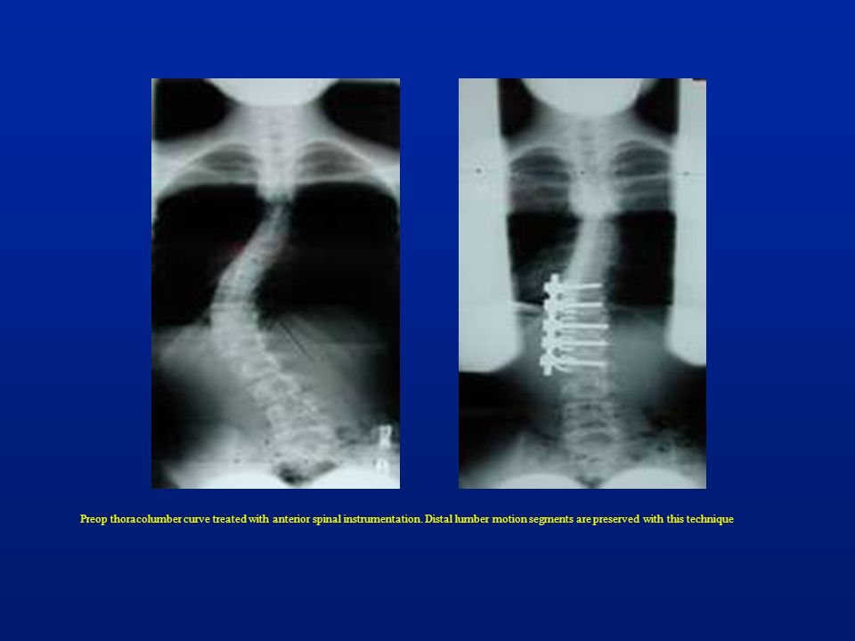 Preop thoracolumber curve treated with anterior spinal instrumentation
