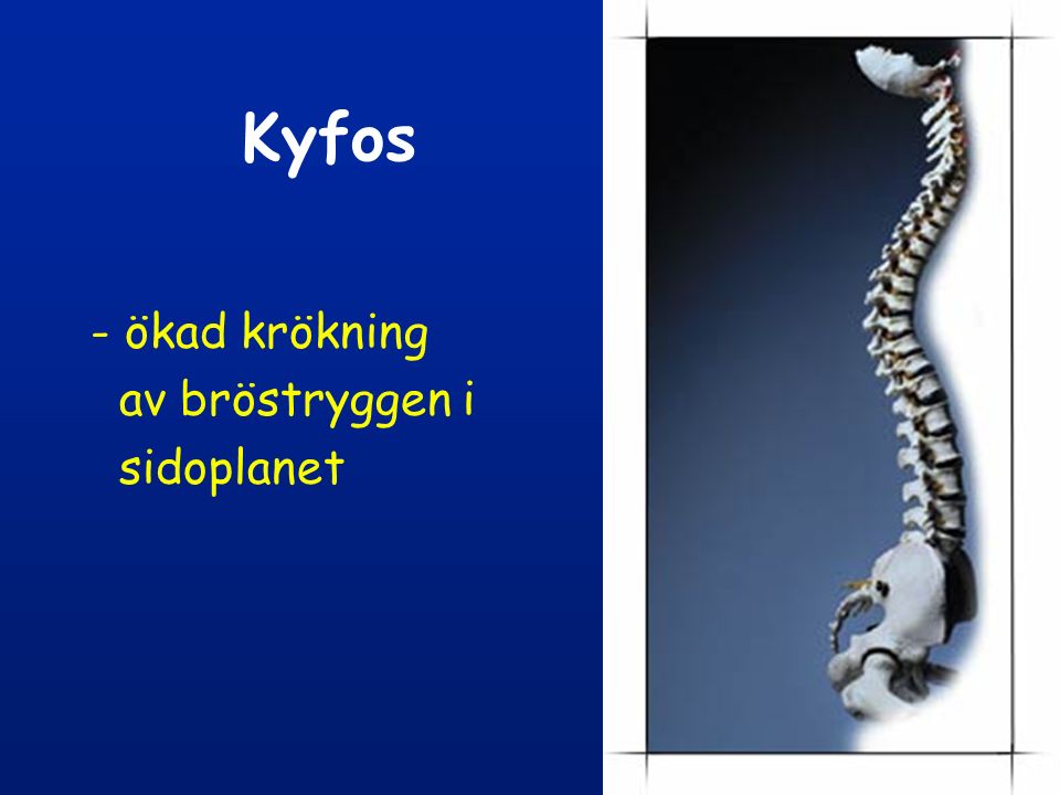 Kyfos - ökad krökning av bröstryggen i sidoplanet