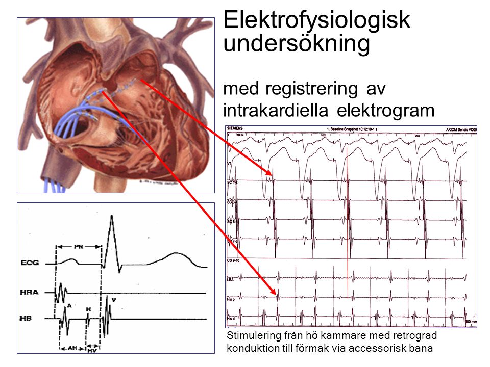 Elektrofysiologisk undersökning med registrering av intrakardiella elektrogram