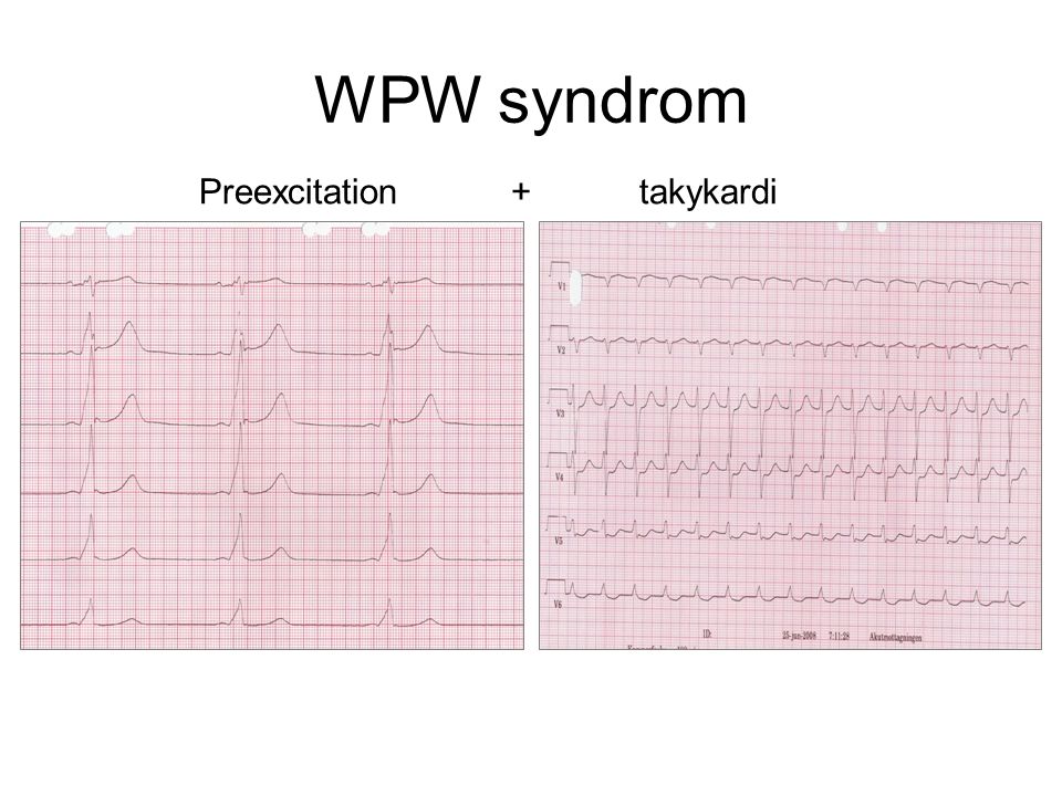 WPW syndrom Preexcitation + takykardi