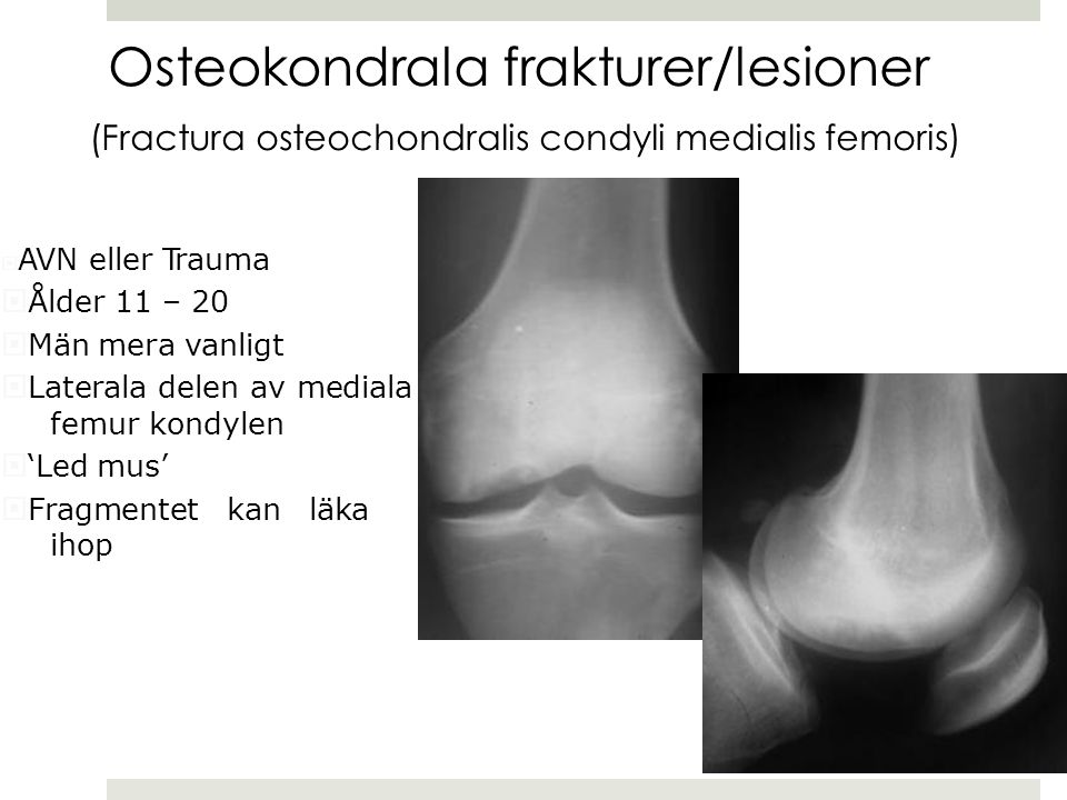 Osteokondrala frakturer/lesioner