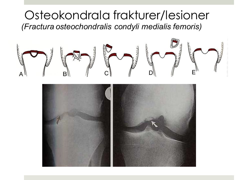Osteokondrala frakturer/lesioner