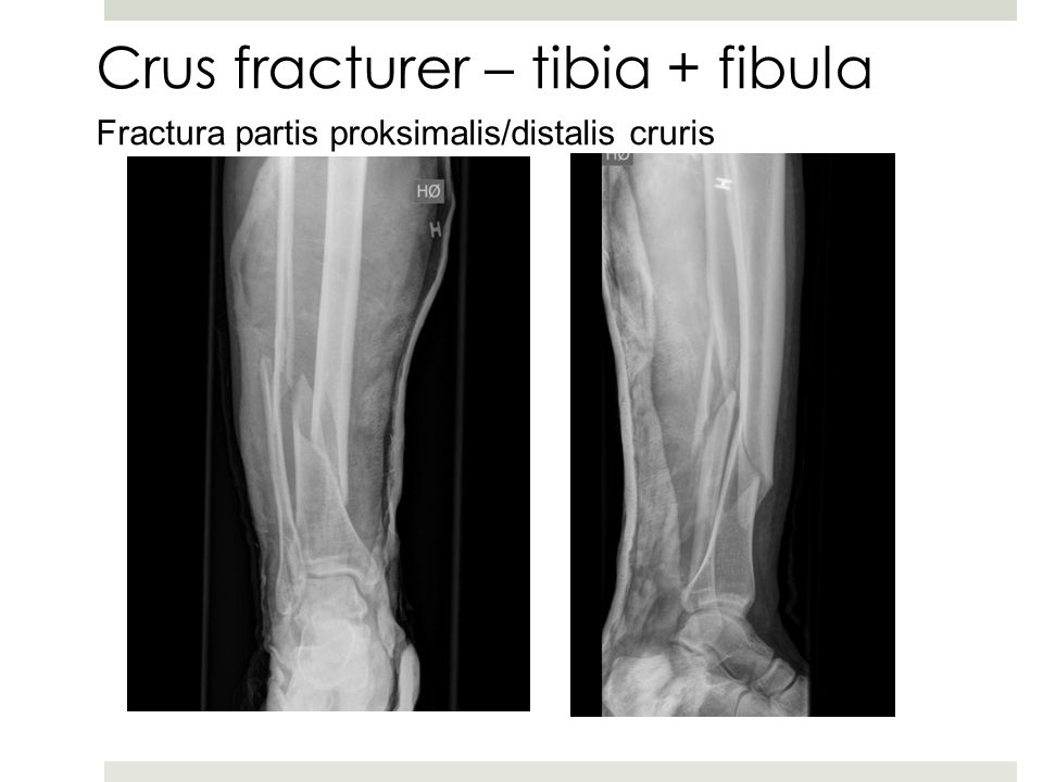Crus fracturer – tibia + fibula