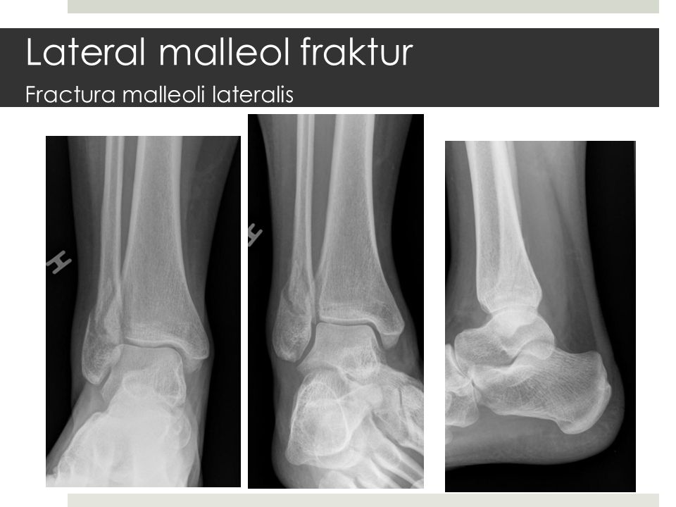 Lateral malleol fraktur Fractura malleoli lateralis