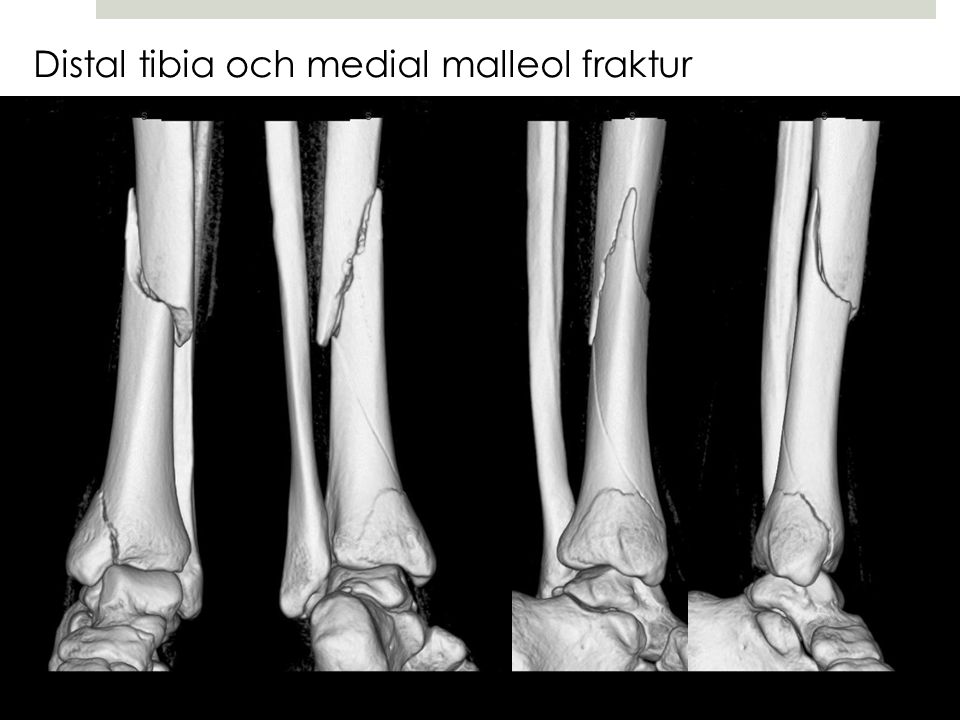 Distal tibia och medial malleol fraktur