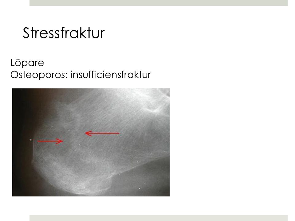 Stressfraktur Löpare Osteoporos: insufficiensfraktur