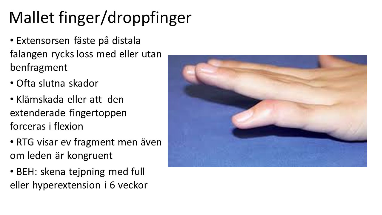 Mallet finger/droppfinger