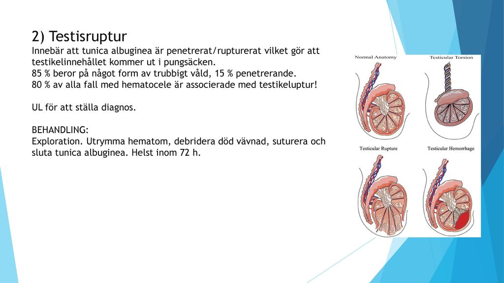2) Testisruptur Innebär att tunica albuginea är penetrerat/rupturerat vilket gör att testikelinnehållet kommer ut i pungsäcken.