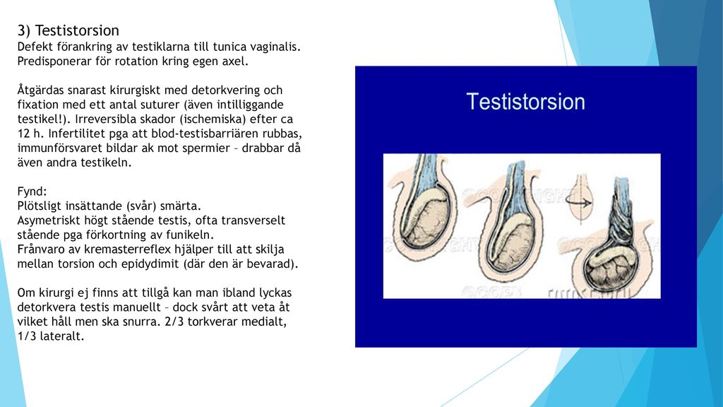 3) Testistorsion Defekt förankring av testiklarna till tunica vaginalis.
