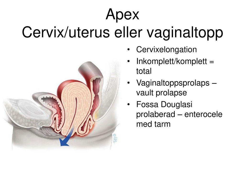 Apex Cervix/uterus eller vaginaltopp