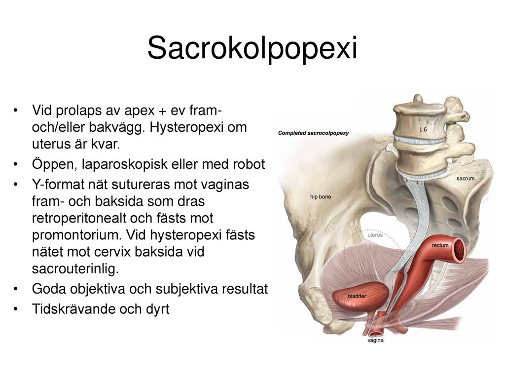 Sacrokolpopexi Vid prolaps av apex + ev fram-och/eller bakvägg. Hysteropexi om uterus är kvar. Öppen, laparoskopisk eller med robot.