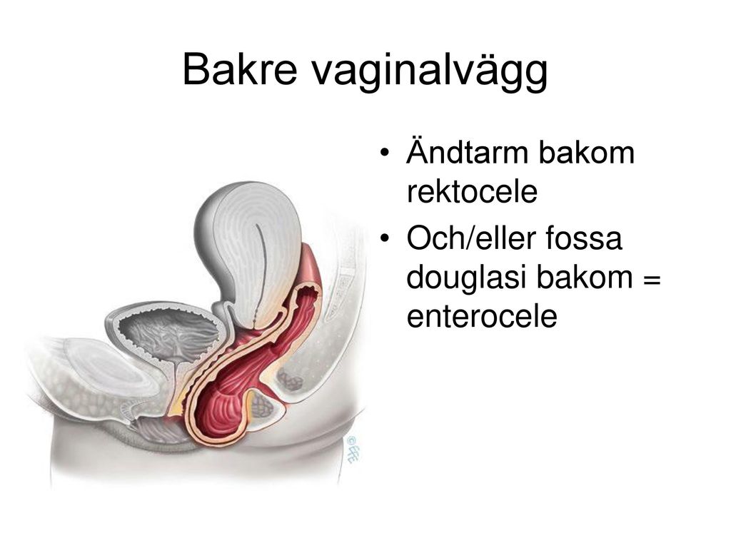 Bakre vaginalvägg Ändtarm bakom rektocele