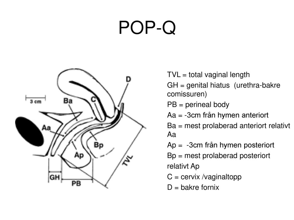 POP-Q TVL = total vaginal length