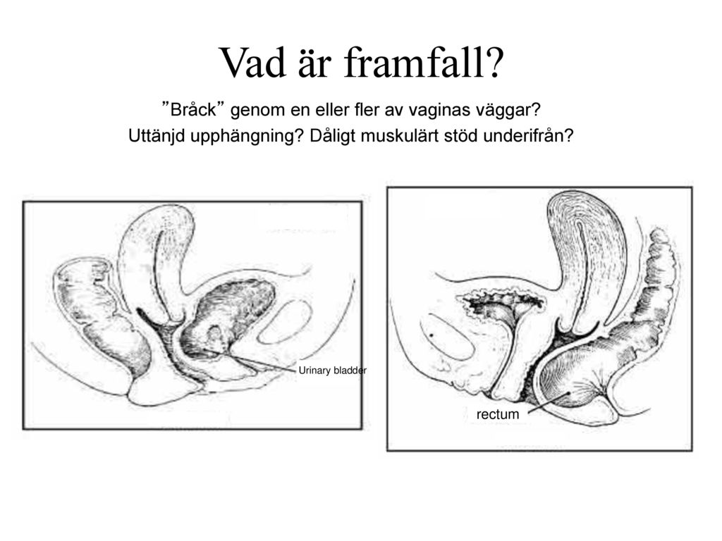 Vad är framfall Bråck genom en eller fler av vaginas väggar