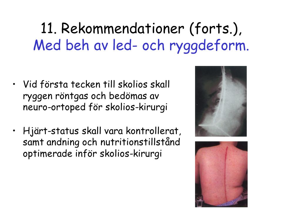 11. Rekommendationer (forts.), Med beh av led- och ryggdeform.
