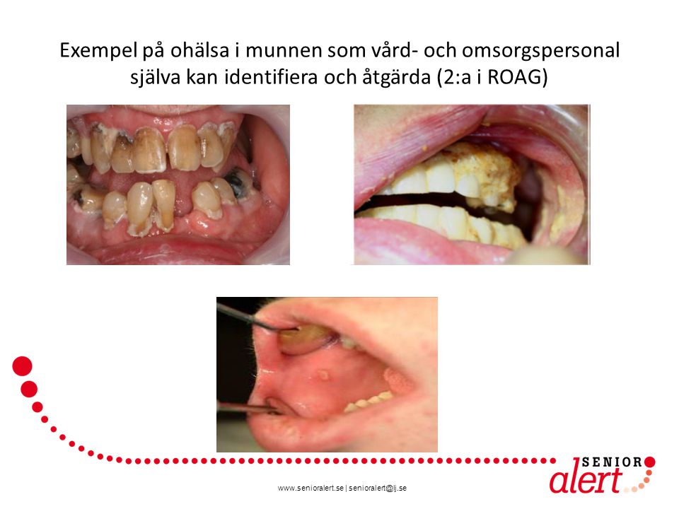 Exempel på ohälsa i munnen som vård- och omsorgspersonal själva kan identifiera och åtgärda (2:a i ROAG)