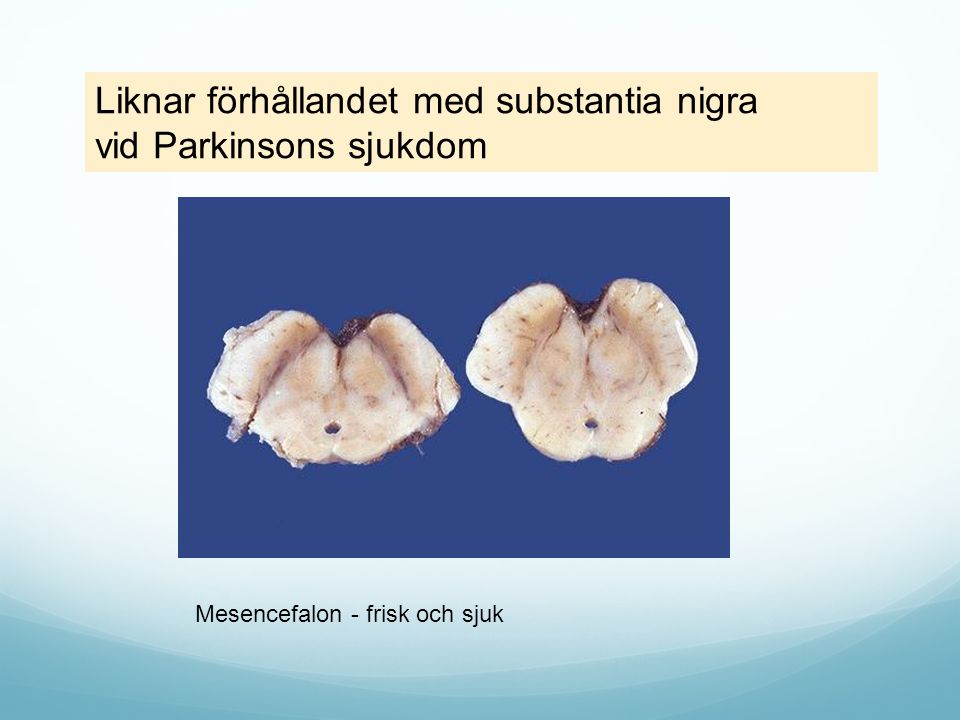 Liknar förhållandet med substantia nigra vid Parkinsons sjukdom