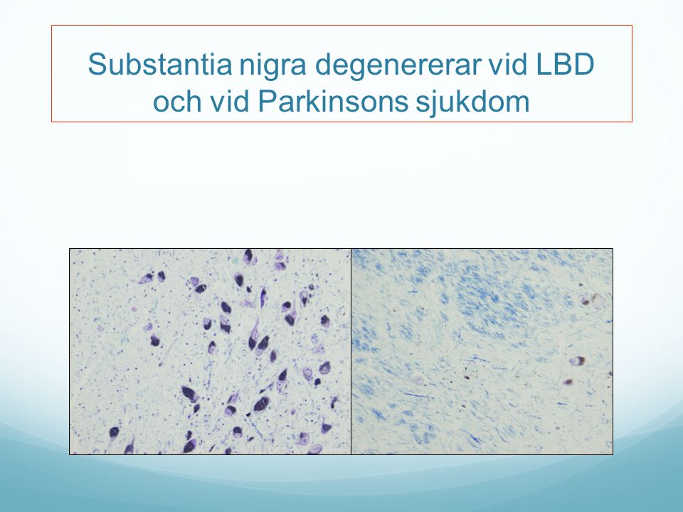 Substantia nigra degenererar vid LBD och vid Parkinsons sjukdom