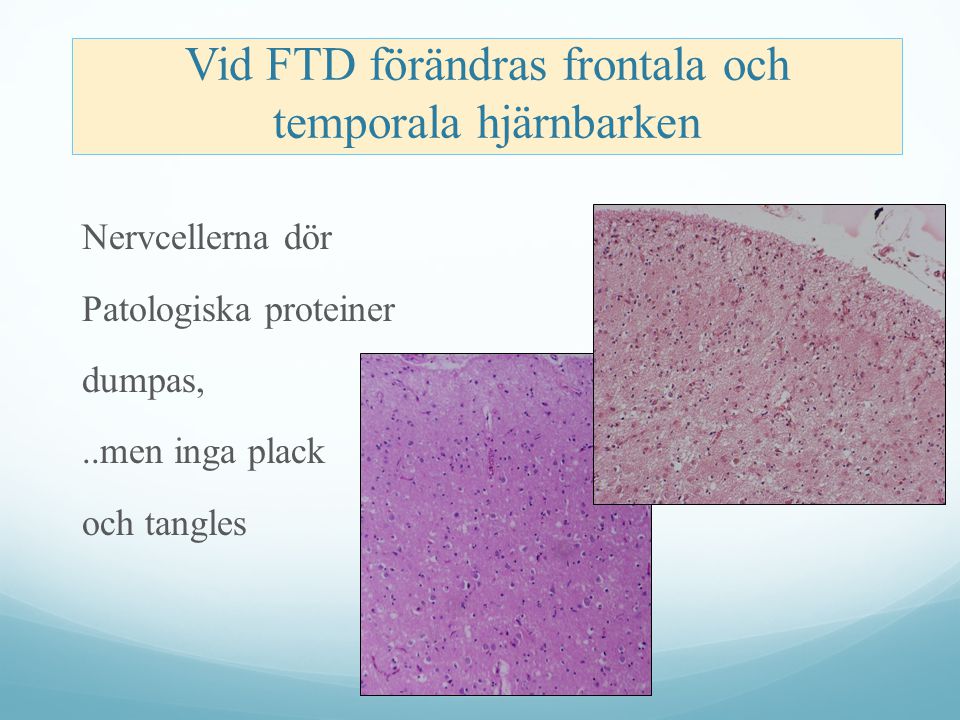 Vid FTD förändras frontala och temporala hjärnbarken