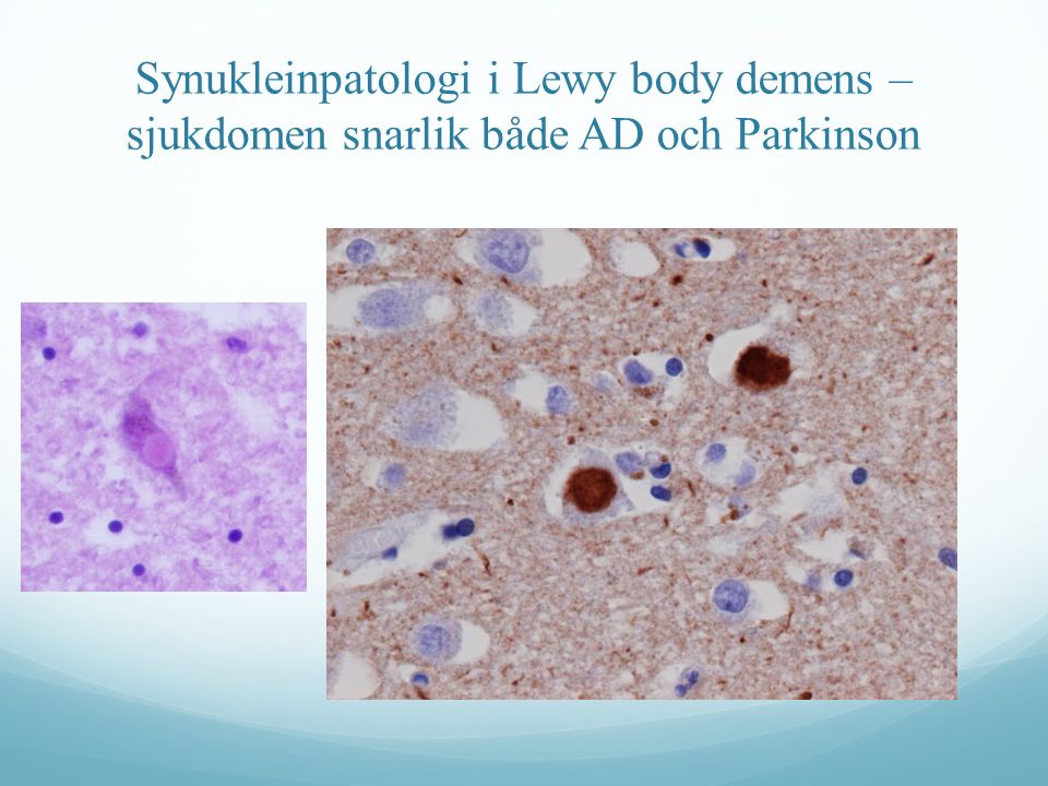 Synukleinpatologi i Lewy body demens – sjukdomen snarlik både AD och Parkinson