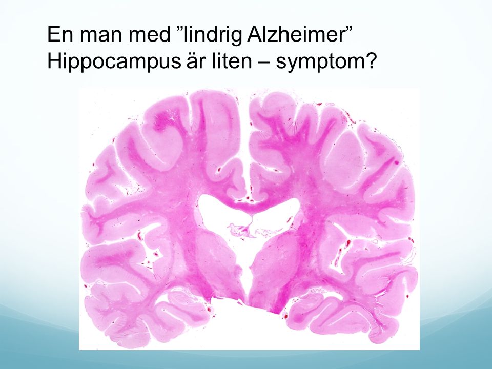 En man med lindrig Alzheimer Hippocampus är liten – symptom