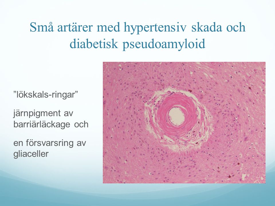 Små artärer med hypertensiv skada och diabetisk pseudoamyloid