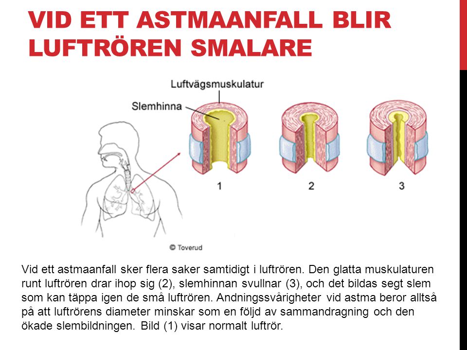 Vid ett astmaanfall blir luftrören smalare