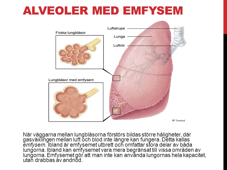 Alveoler med emfysem