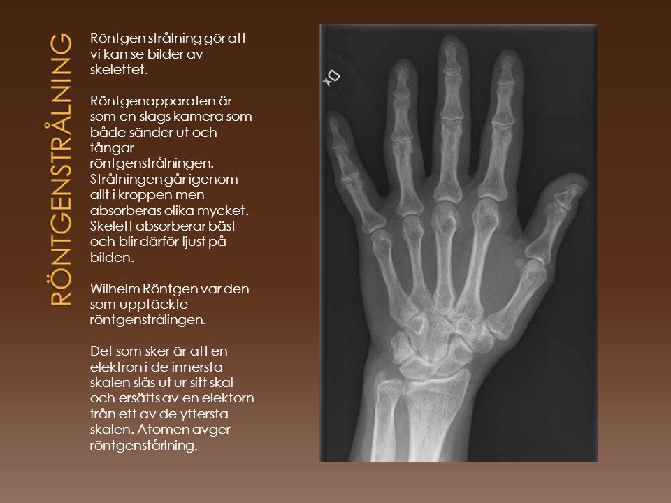röntgenstrålning Röntgen strålning gör att vi kan se bilder av skelettet.
