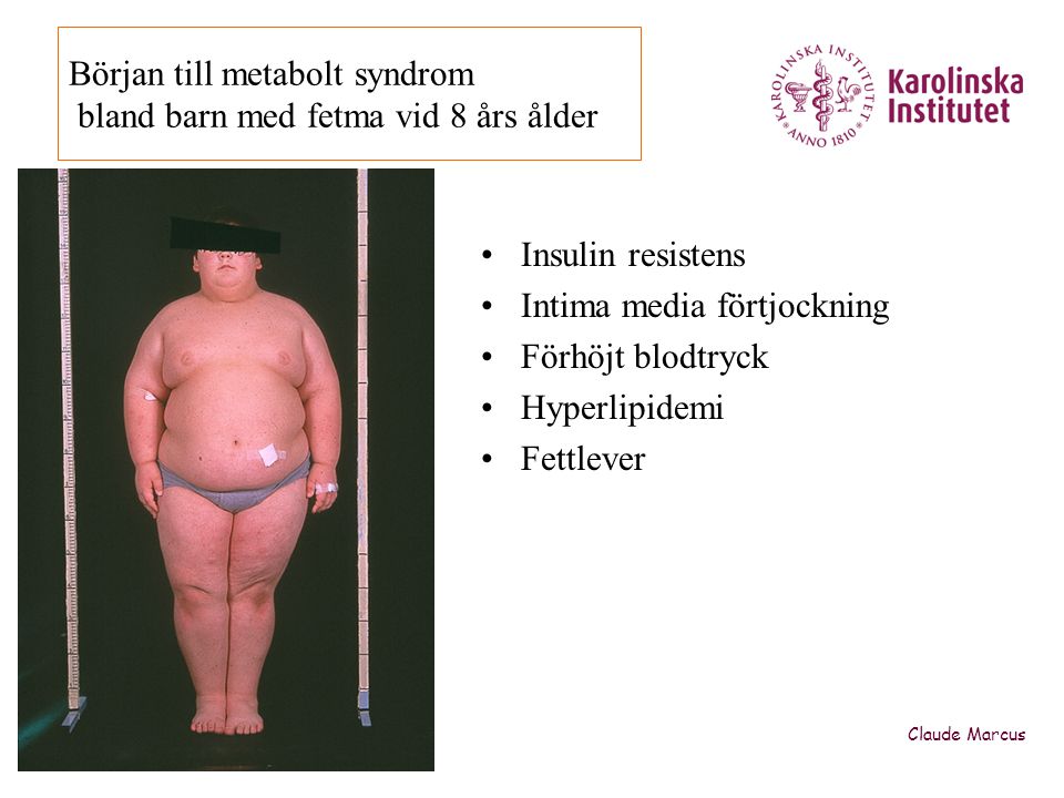 Början till metabolt syndrom bland barn med fetma vid 8 års ålder