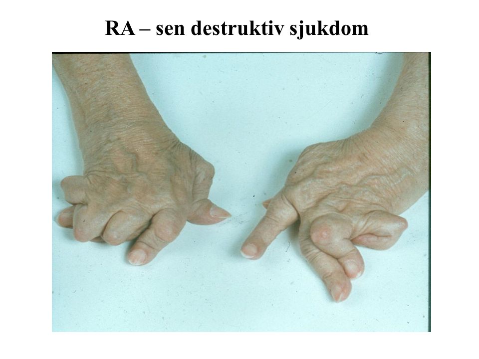 RA – sen destruktiv sjukdom