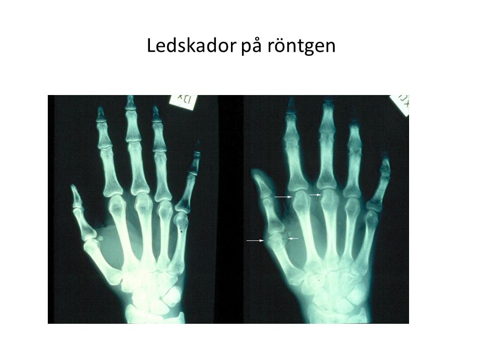 Ledskador på röntgen