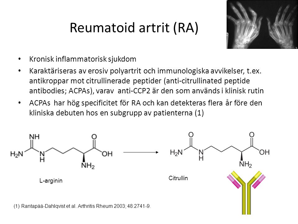Reumatoid artrit (RA) Kronisk inflammatorisk sjukdom