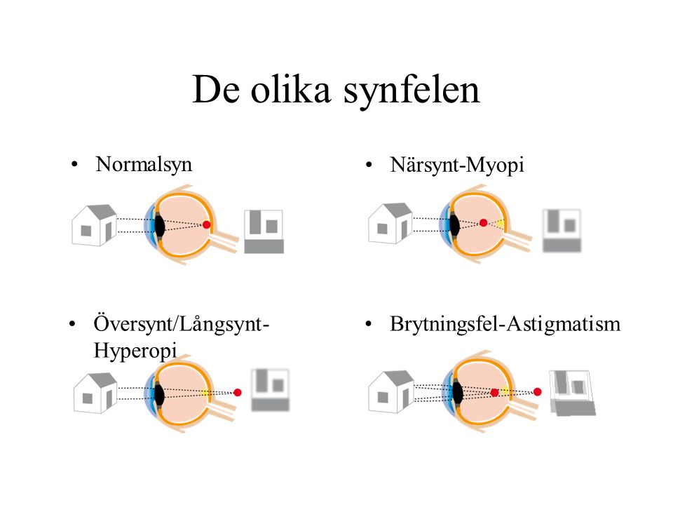 De olika synfelen Normalsyn Närsynt-Myopi Översynt/Långsynt-Hyperopi