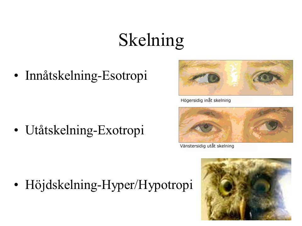 Skelning Innåtskelning-Esotropi Utåtskelning-Exotropi