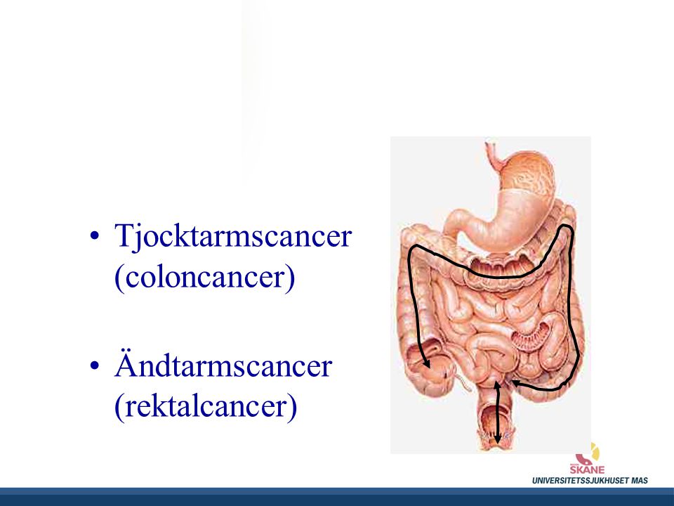 Tjocktarmscancer (coloncancer)